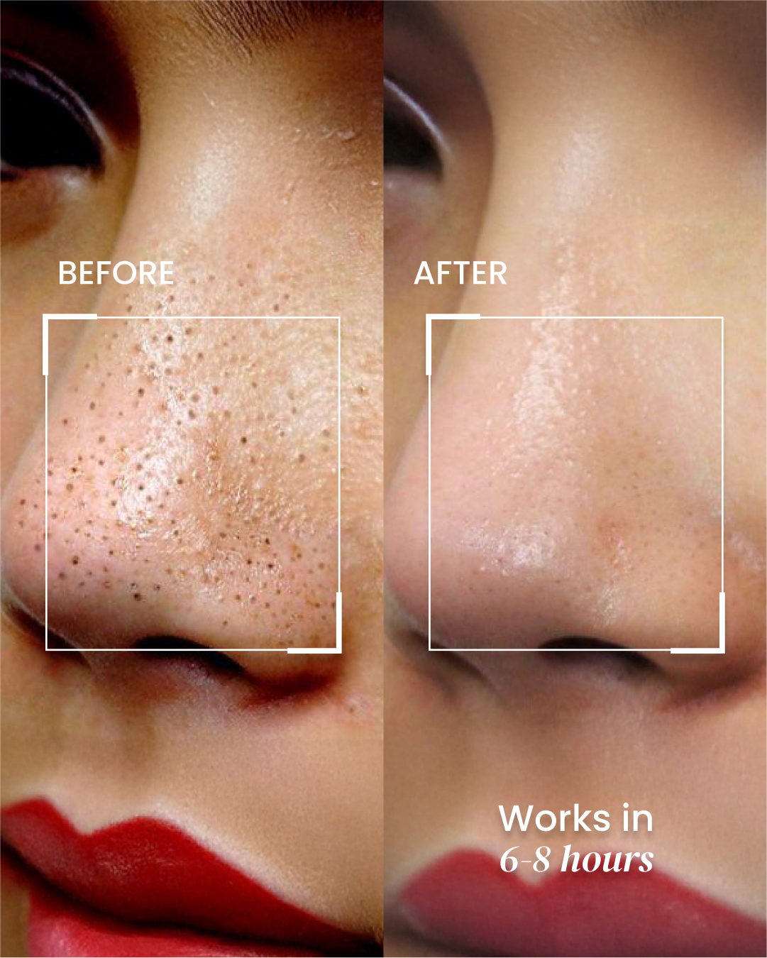 Nose Pimple Patch